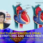 Patent DuctusArteriosus PDA Causes Symptoms and Treatment 85x85